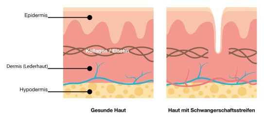 Hautaufbau und Schwangerschaftsstreifen